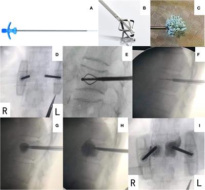 A retrospective cohort study on the efficacy and safety of percutaneous vertebroplasty combined with bone-filling mesh container in vertebral metastases with posterior wall defect